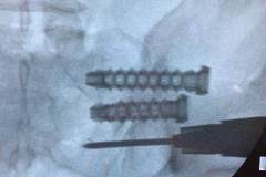 SACROILIAC FUSION IMPLANT XRAY